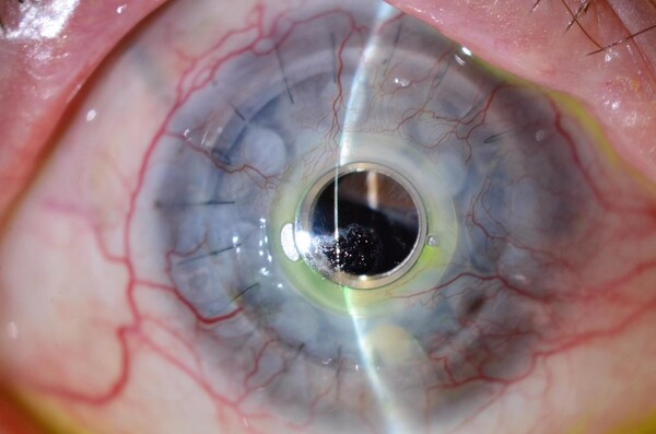 Keratoprotesis img06